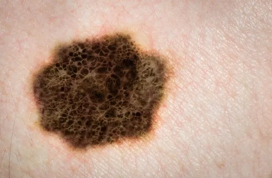 Malignt melanom Copyright: Australisphotography/Dreamstime.com