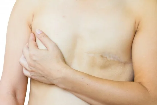 Kvinna som drabbats av bröstcancer Copyright: Tawatchai Khid-arn/Dreamstime.com