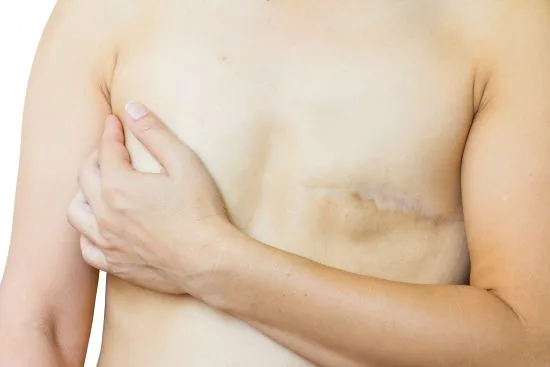 Bröstcancerpatient copyright: Dreamstime.com